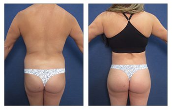 Difference Between a Butt Lift and a Butt Tuck