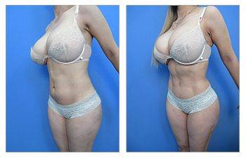 A Flatter Tummy and Naturally Enhanced Breasts: What AirSculpt Did