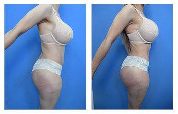 Laser Lipo 360 for Slim, Toned Abs & Love Handles Before & After Photos New  Jersey - Reflections Center