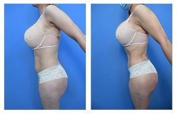 Airsculpt Liposuction vs VASER HD Lipo