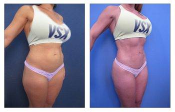 High Definition Liposuction Cost