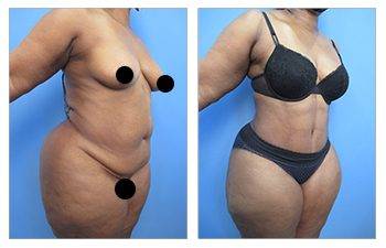 Best Liposuction Surgeon