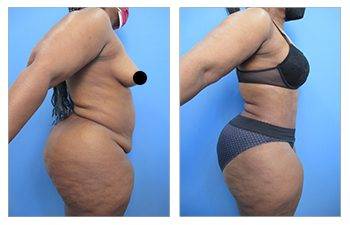 Best Liposuction Surgeon