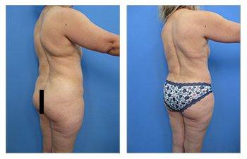 Back Liposuction