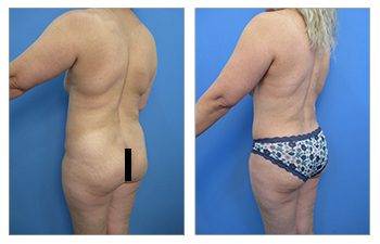 Back Liposuction