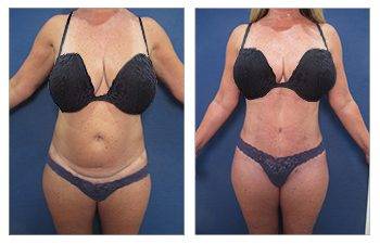 tummy tuck results