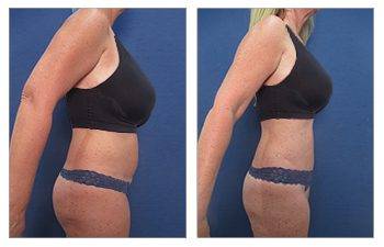 tummy tuck results