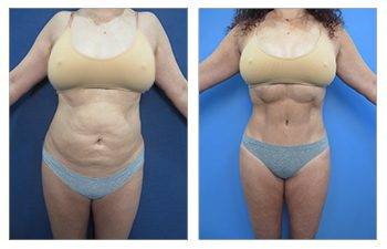 360 Liposuction, SurgiSculpt