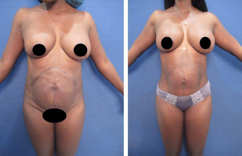 Mommy Makeover Tummy Tuck