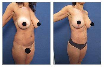 Tummy Tuck Newport Beach