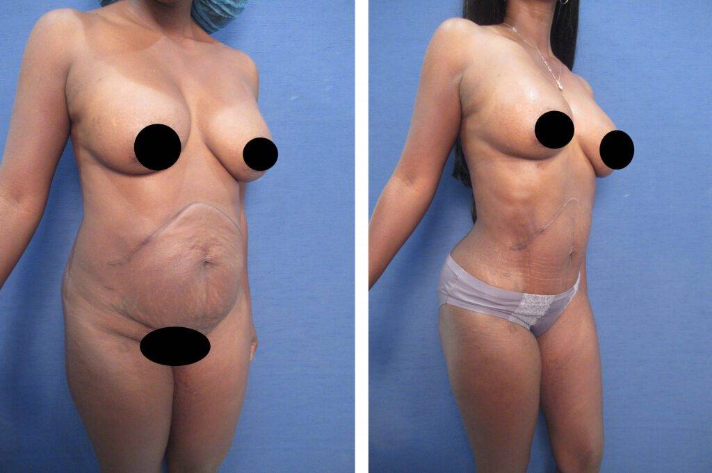 Mommy Makeover Tummy Tuck