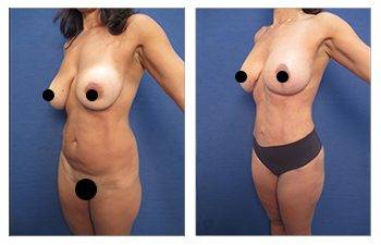 Tummy Tuck Newport Beach