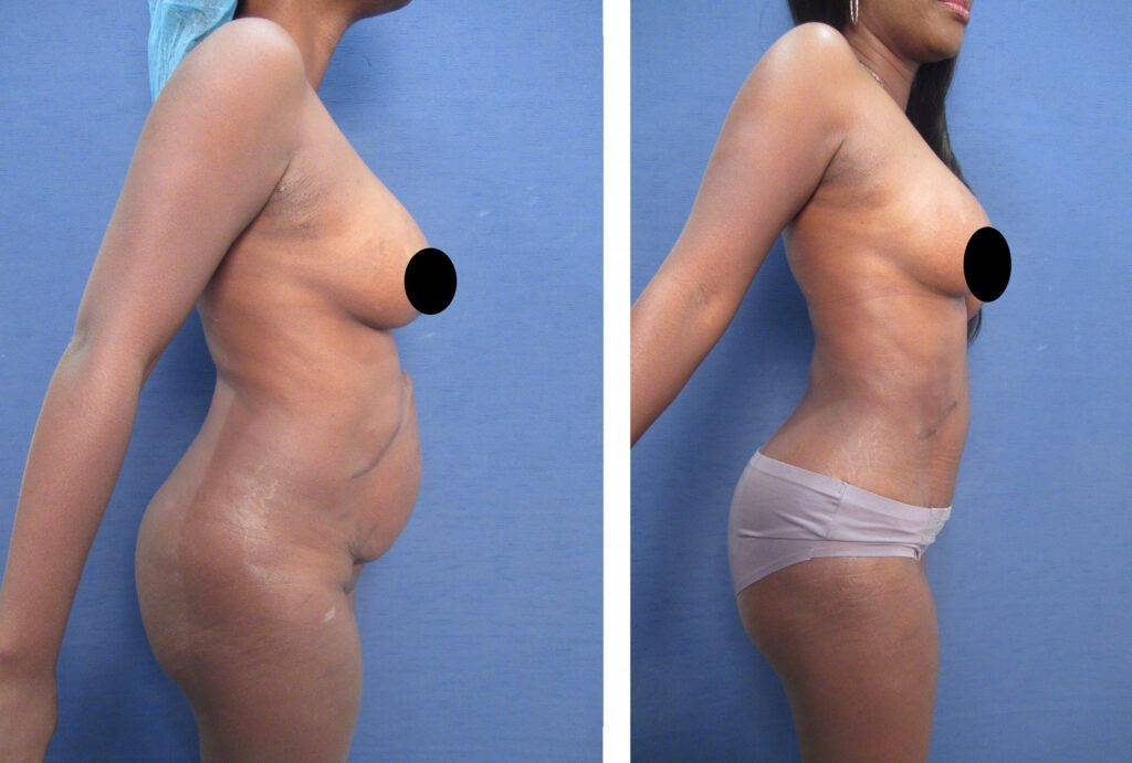 Mommy Makeover Tummy Tuck