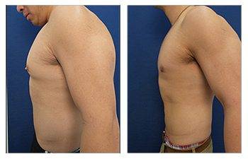 Gynecomastia Cost