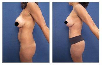 Tummy Tuck Newport Beach