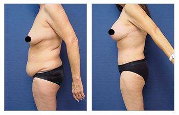 Decreasing Girth With Tummy Tuck