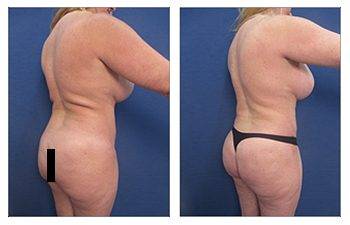 Back Liposuction