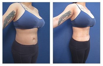 HD Liposuction 360, SurgiSculpt