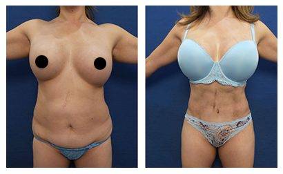 Tummy Tuck Muscle Repair