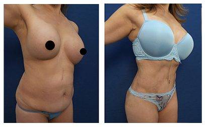 CAN I HAVE A TUMMY TUCK WITHOUT MUSCLE TIGHTENING?