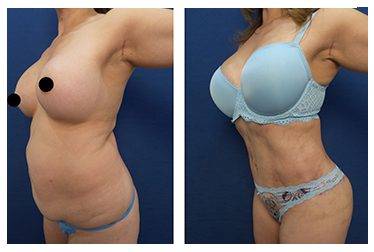 Tummy Tuck Muscle Repair