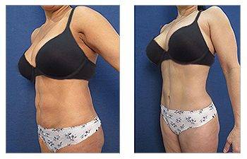 Sculpt Your Lower Abdomen with the Mini Tummy Tuck