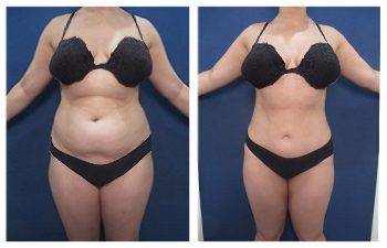 Skinny Little BBL Before & After Photos, Westfield, NJ