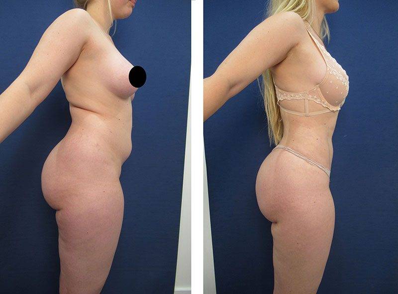 What Is The Safe Volume For Liposuction?