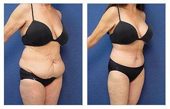 Decreasing Girth With Tummy Tuck