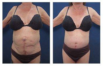 Eliminating A Bulging Belly With A Tummy Tuck