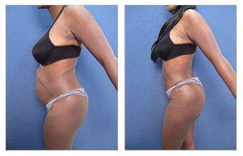 Mommy Makeover Tummy Tuck  bilateral breast reduction