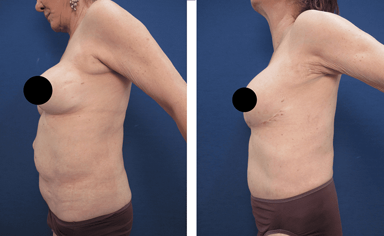 Eliminating A Bulging Belly With A Tummy Tuck