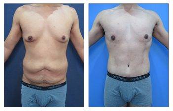 Male liposuction of the Abdomen