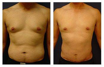 How To Perform the Gynecomastia Pinch Test At Home