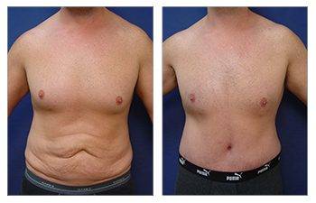 Male breast surgery versus gynecomastia surgery