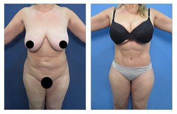 High Bmi / Plus Size Awake Liposuction: An Exciting Option