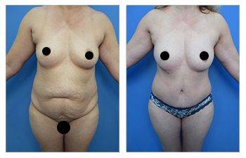 Tummy tuck for plus sized clients