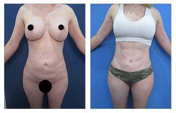 Best Liposuction Surgeon in Los Angeles