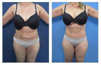 Best Liposuction for plus sized clients