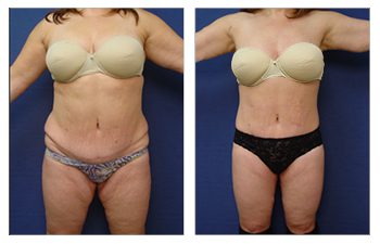 Cabbabe Plastic Surgery - Plus size tummy tuck (BMI 36) 3 months post op.  .. Plus size patients have a BMI>30. These patients have protuberant  abdomens as a result of visceral fat