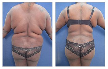 Brazilian Buttock lift for plus sized clients