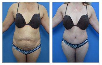 Tummy tuck for plus sized clients