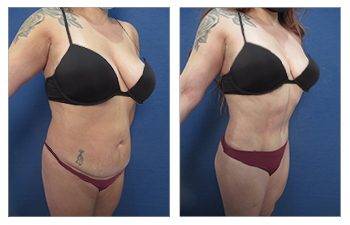 Pros and Cons of Lipo 360 vs Tummy Tuck 