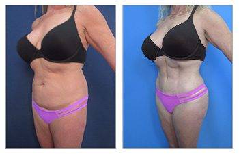 Cabbabe Plastic Surgery - Plus size tummy tuck (BMI 36) 3 months post op.  .. Plus size patients have a BMI>30. These patients have protuberant  abdomens as a result of visceral fat