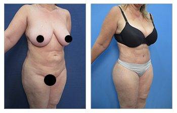 Liposuction for plus sized clients