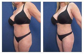 Why is VASER liposuction ideal for Brazilian Buttock Lift