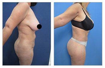 Liposuction for plus sized clients