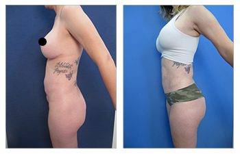 Liposuction Surgeon in Los Angeles