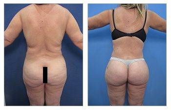 Ozempic vs. VASER Liposuction: Here's How to Choose - 360 Plastic Surgery