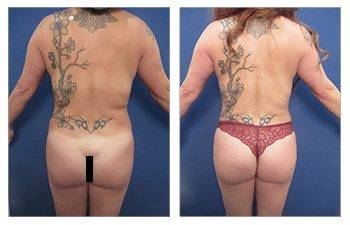 360 Liposuction